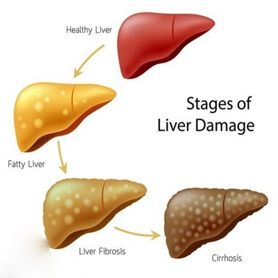 فیبروز کبدی و راه‌های درمان و پیشگیری آن