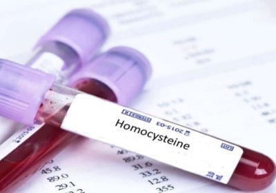 همه چیز درباره بیماری هموسیستینوری و علائم آن