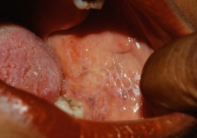 لیکن پلان: تشخیص، علائم و گزینه‌های درمانی موثر